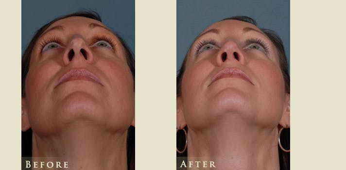 Aesthetic Rhinoplasty Before & After Gallery - Patient 754906 - Image 4