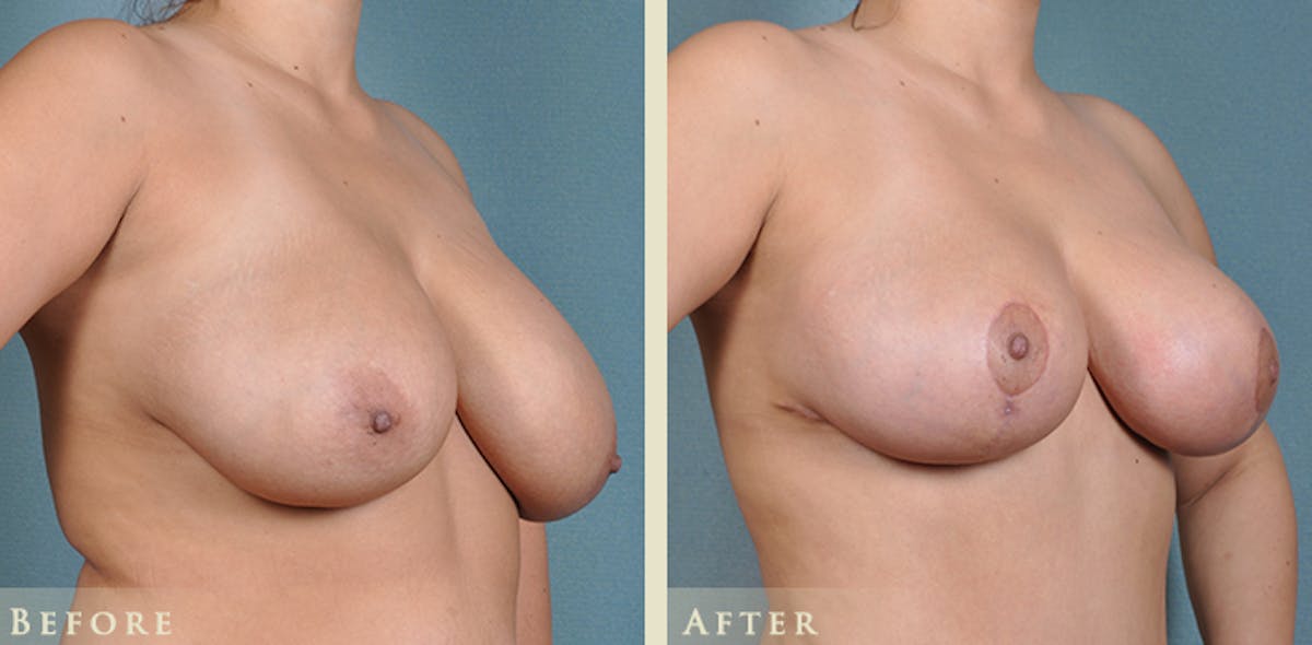 Breast Reduction Before & After Gallery - Patient 398898 - Image 2