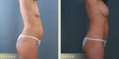 Mommy Makeover Before & After Gallery - Patient 390486 - Image 4