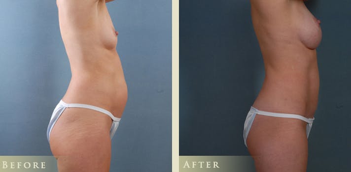 Mommy Makeover Before & After Gallery - Patient 390486 - Image 4