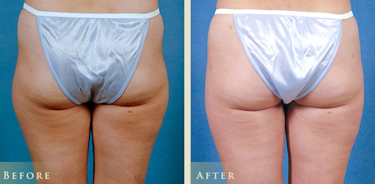 Female Liposuction Before & After Gallery - Patient 279287 - Image 2