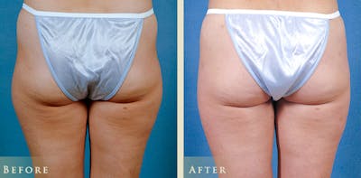 Female Liposuction Before & After Gallery - Patient 279287 - Image 2