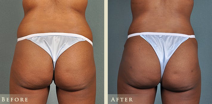 Brazilian Butt Lift Before & After Gallery - Patient 342065 - Image 1