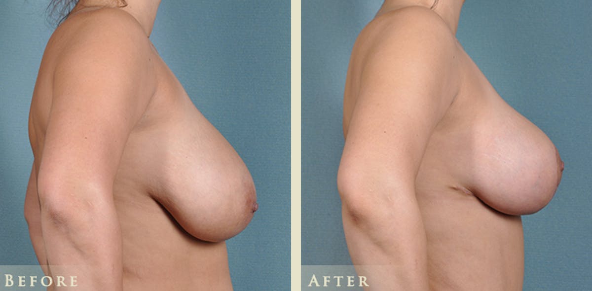 Breast Reduction Before & After Gallery - Patient 398898 - Image 3