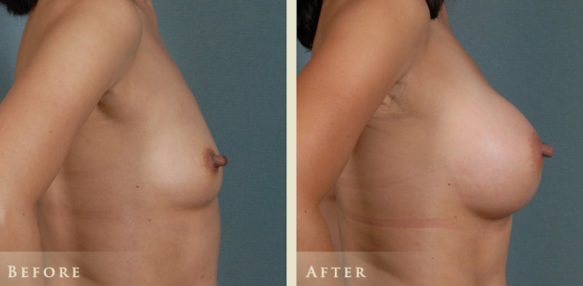 Breast Augmentation with Silicone Implants Before & After Gallery - Patient 158092 - Image 3