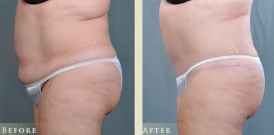 Tummy Tuck Before & After Gallery - Patient 257737 - Image 3