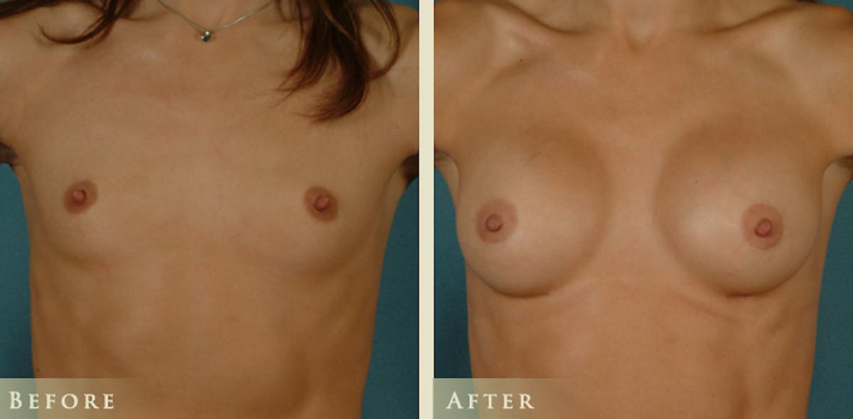 Breast Augmentation with Saline Implants Before & After Gallery - Patient 670345 - Image 1