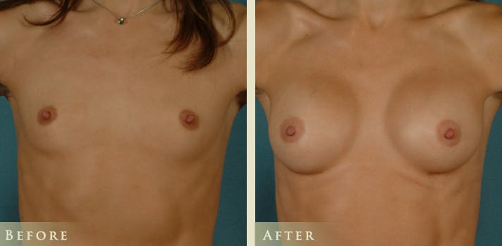 Breast Augmentation Before & After Gallery - Patient 377775 - Image 1