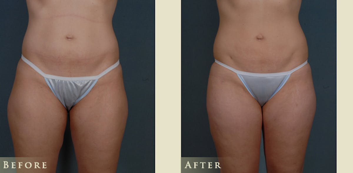 Female Liposuction Before & After Gallery - Patient 309315 - Image 1
