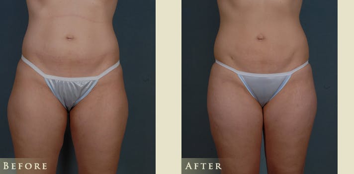 Female Liposuction Before & After Gallery - Patient 309315 - Image 1