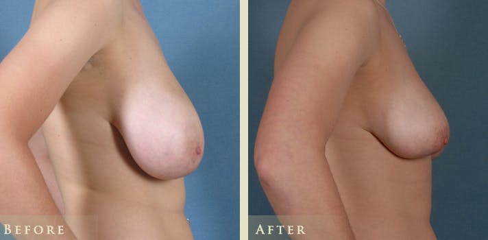 Breast Reduction Before & After Gallery - Patient 263477 - Image 3