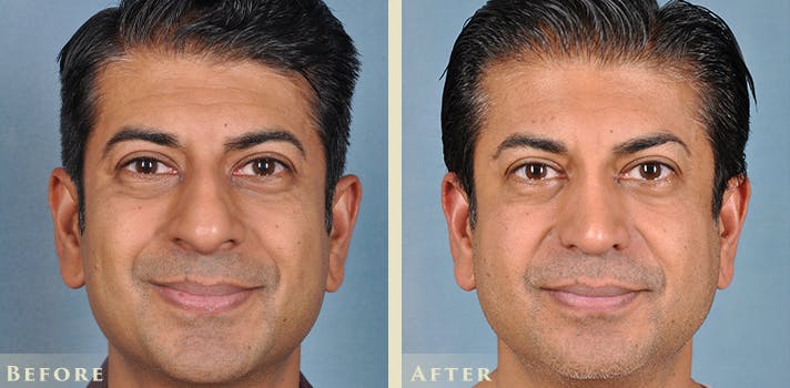Aesthetic Rhinoplasty Before & After Gallery - Patient 103880 - Image 1