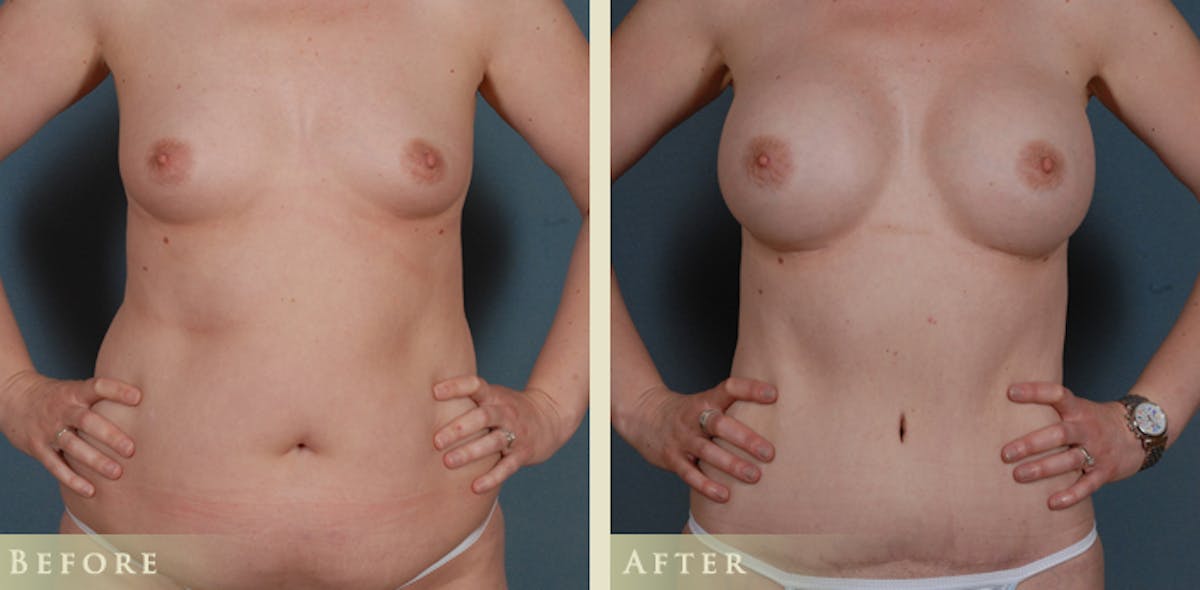 Mommy Makeover Before & After Gallery - Patient 287844 - Image 1