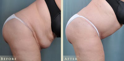 Tummy Tuck Before & After Gallery - Patient 257737 - Image 4