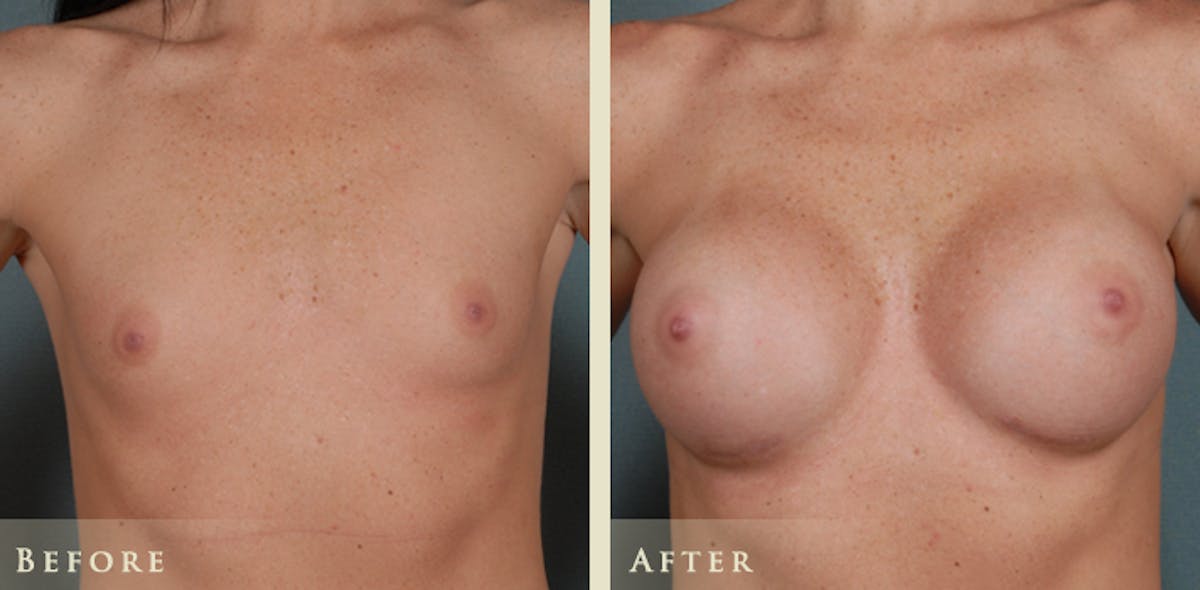 Breast Augmentation with Silicone Implants Before & After Gallery - Patient 104457 - Image 1