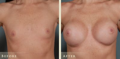 Breast Augmentation Before & After Gallery - Patient 104457 - Image 1