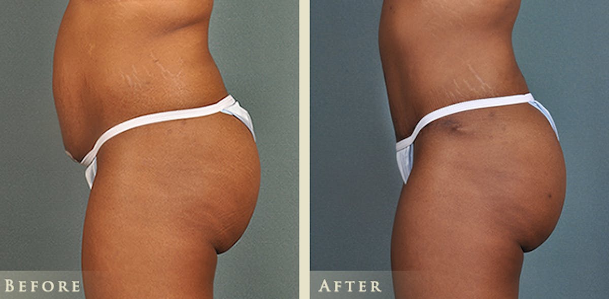 Brazilian Butt Lift Before & After Gallery - Patient 342065 - Image 2
