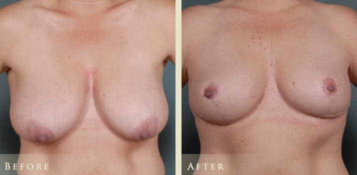 Breast Lift Before & After Gallery - Patient 317404 - Image 1