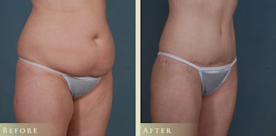 Mommy Makeover Before & After Gallery - Patient 287844 - Image 2