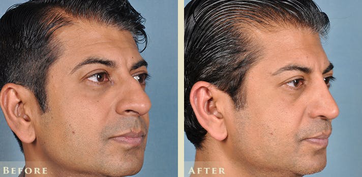 Aesthetic Rhinoplasty Before & After Gallery - Patient 103880 - Image 2