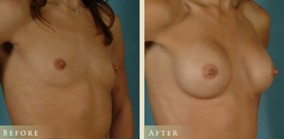 Breast Augmentation with Saline Implants Before & After Gallery - Patient 670345 - Image 2