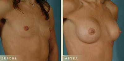 Breast Augmentation Before & After Gallery - Patient 377775 - Image 2