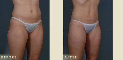 Female Liposuction Before & After Gallery - Patient 309315 - Image 2