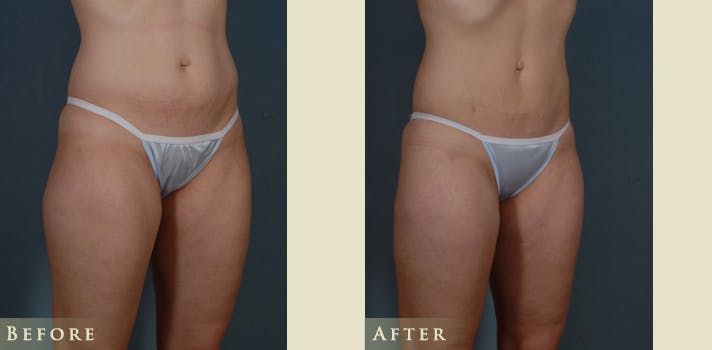Female Liposuction Before & After Gallery - Patient 309315 - Image 2
