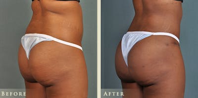 Brazilian Butt Lift Before & After Gallery - Patient 342065 - Image 3