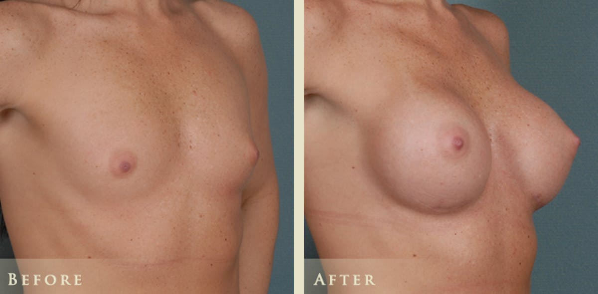 Breast Augmentation with Silicone Implants Before & After Gallery - Patient 104457 - Image 2