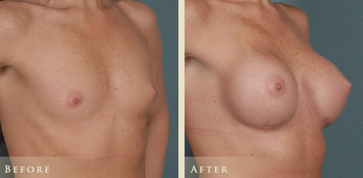Breast Augmentation Before & After Gallery - Patient 104457 - Image 2