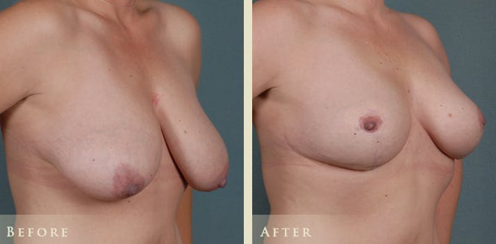 Breast Lift Before & After Gallery - Patient 317404 - Image 2
