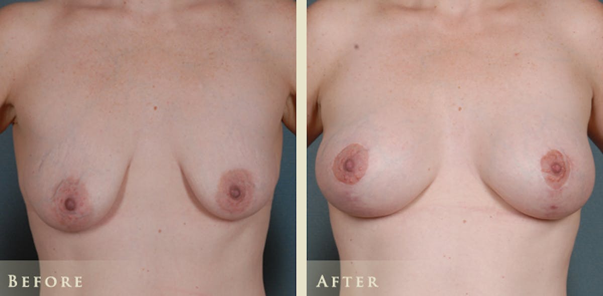 Breast Augmentation and Lift  Before & After Gallery - Patient 323669 - Image 1