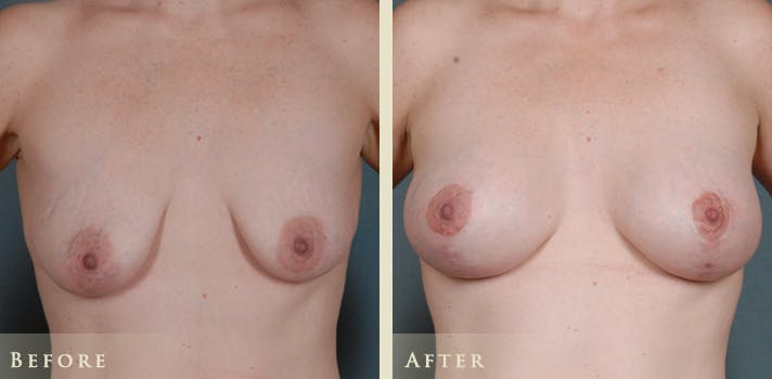 Breast Augmentation and Lift  Before & After Gallery - Patient 323669 - Image 1