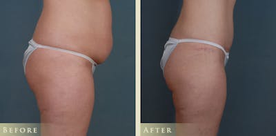 Mommy Makeover Before & After Gallery - Patient 287844 - Image 3