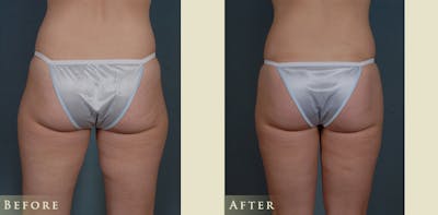 Female Liposuction Before & After Gallery - Patient 309315 - Image 3