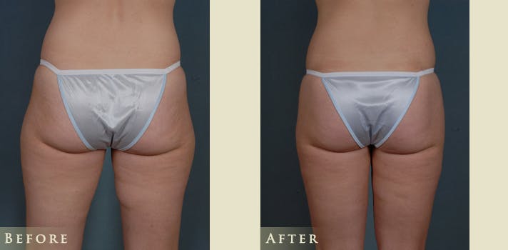 Female Liposuction Before & After Gallery - Patient 309315 - Image 3
