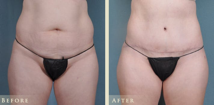 Tummy Tuck Before & After Gallery - Patient 426835 - Image 1