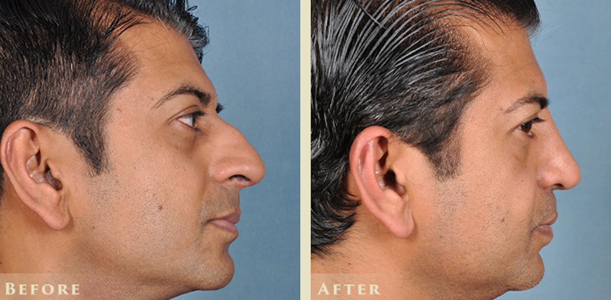 Aesthetic Rhinoplasty Before & After Gallery - Patient 103880 - Image 3