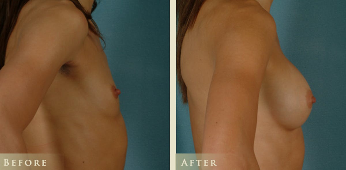Breast Augmentation with Saline Implants Before & After Gallery - Patient 670345 - Image 3