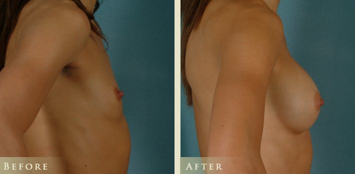 Breast Augmentation Before & After Gallery - Patient 377775 - Image 3