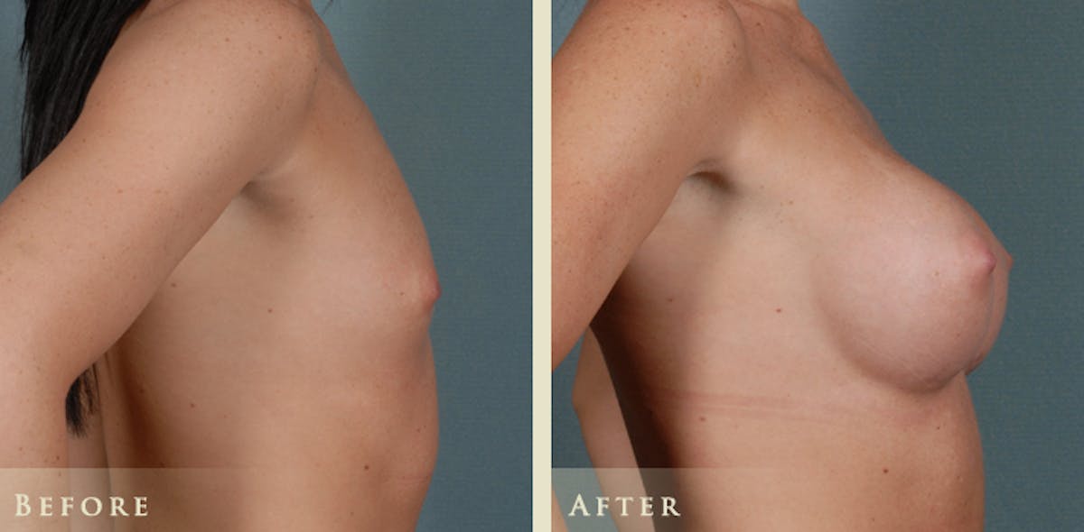 Breast Augmentation with Silicone Implants Before & After Gallery - Patient 104457 - Image 3