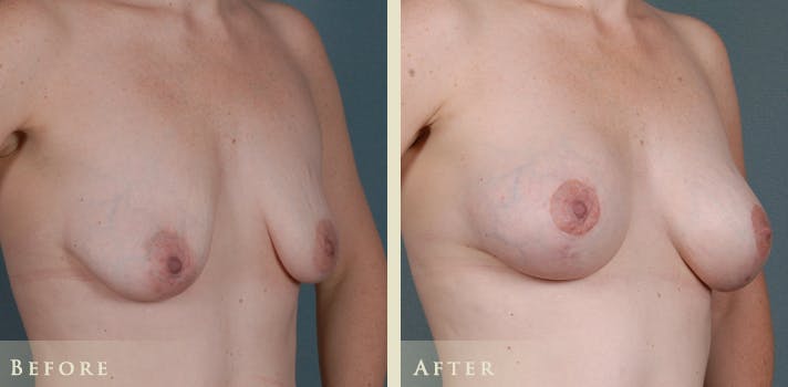 Breast Augmentation and Lift  Before & After Gallery - Patient 323669 - Image 2