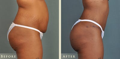 Brazilian Butt Lift Before & After Gallery - Patient 342065 - Image 4
