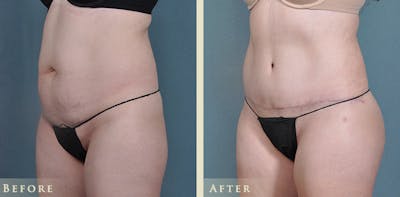Tummy Tuck Before & After Gallery - Patient 426835 - Image 2