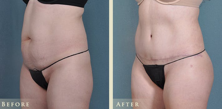 Tummy Tuck Before & After Gallery - Patient 426835 - Image 2