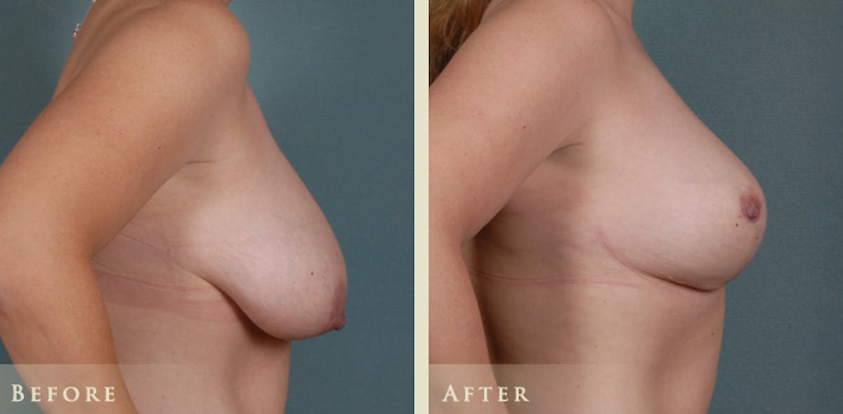 Breast Reduction Before & After Gallery - Patient 214983 - Image 3