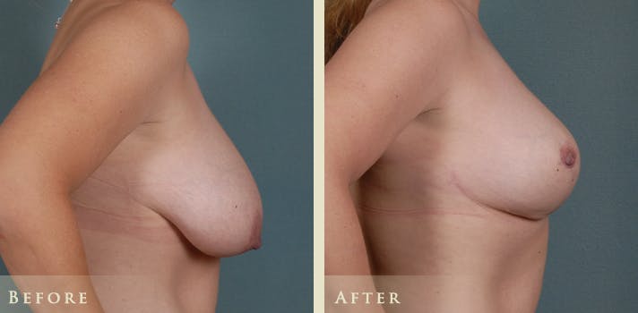 Breast Lift Before & After Gallery - Patient 317404 - Image 3