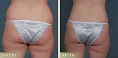 Mommy Makeover Before & After Gallery - Patient 287844 - Image 4