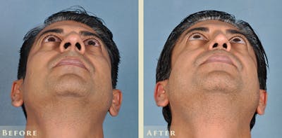 Aesthetic Rhinoplasty Before & After Gallery - Patient 103880 - Image 4